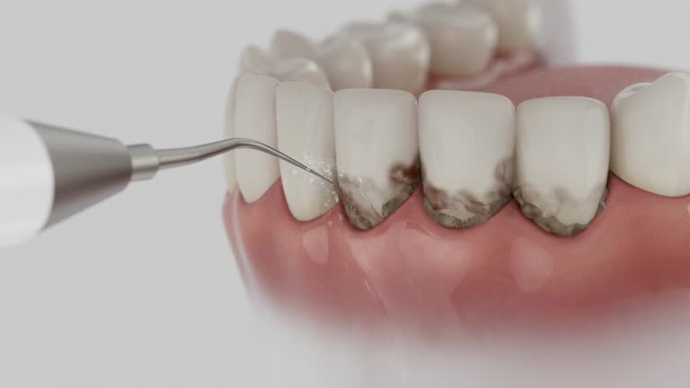 Trusted Dental Crowns And Bridges service in Kingstowne, VA - Dentist Open Now